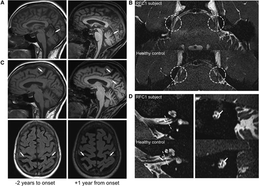 MRI evidence of multisystemic supra- and infratentorial neurodegeneration in RFC1-disease, presenting clinically only with sensory neuropathy. MRI showing cerebellar atrophy (A, sagittal T1) and parietal atrophy (C; sagittal T2 and axial FLAIR) already 2 years before (left column) and 1 year after (right column) the onset of sensory symptoms, with visible progression already in this short time-frame, all still subclinical. High-resolution imaging also revealed severe atrophy of the trigeminal nerve (B, axial T2 SPACE), and vestibular nerve (D, sagittal T2 SPACE). Dashed lines indicate coronal plane demonstrated in the right column of D.