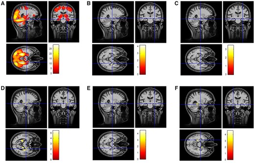 Functional MRI results. (A) The whole-brain novelty response in the full sample (healthy controls, SCD, MCI) without any covariates. (B) Results of an interaction analysis with CSF total-tau levels and amyloid status (binary variable; amyloid-positive Aβ42 < 638.7 and amyloid-negative Aβ42 ≥ 638.7) on novelty activation (covariates age, sex, MRI site, years of education, left and right hippocampal volume). Including diagnosis as an additional covariate did not change the results substantially. (C) Results of an interaction analysis with CSF phospho-tau levels and amyloid status on novelty activation. Including diagnosis as a covariate in this analysis did not change the results substantially. (D) A group-specific regression analysis in amyloid-positive individuals showing the correlation between CSF total-tau levels and medial temporal novelty responses (covariates age, sex, MRI site, years of education, left and right hippocampal volume and Aβ42 CSF levels). This finding remained stable with a slightly lower significance and cluster sizes when including diagnosis as a covariate. (E) A group-specific regression analysis in amyloid-positive individuals showing the correlation between CSF phospho-tau levels (covariates age, sex, MRI site, years of education, left and right hippocampal volume and Aβ42 CSF levels). This finding remained stable with a slightly lower significance and cluster size when including diagnosis as a covariate. (F) A group-specific regression analysis in amyloid-positive individuals (covariates age, sex, years of education, MRI site, diagnosis, Aβ42 CSF levels) showing the correlation between dprime and novelty responses.