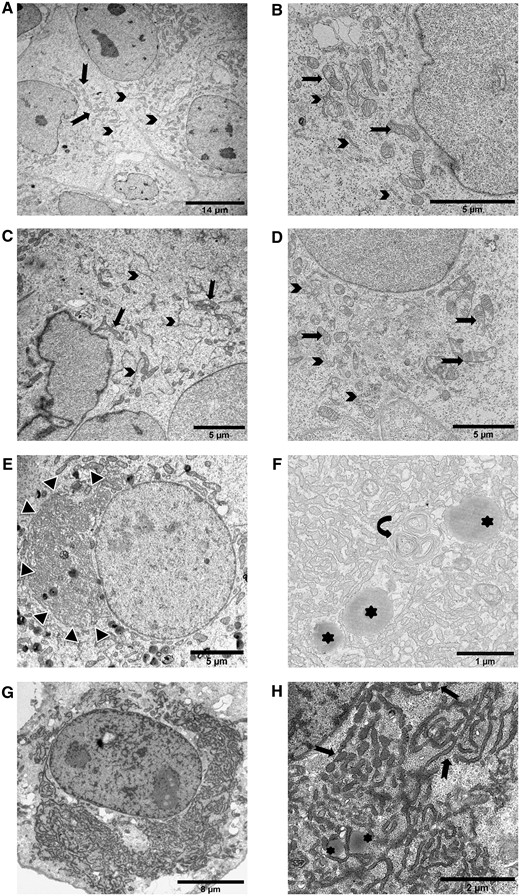 ER morphological alterations induced by NP1 mutants are detected by transmission electron microscopy. For each condition, pictures representative of the characteristic observations are included. ER is indicated by arrows, mitochondria by arrowheads, lysosomes by asterisks. (A and B) Electron microscopy of non-transfected COS7 cells showed normal development of endoplasmic reticulum and mitochondria at low (A) and high magnification (B). (C and D) COS7 cells transfected with the wild-type NP1 plasmid. No modification of cellular organelles was observed at low (C) or high (D) magnification. (E and F) COS7 cells transfected with the p.E327G mutant plasmid showed a single juxtanuclear cluster of ER (E, black and white arrowheads). On high magnification (F), ER cisternae intermingled with some lysosomes and multilamellar bodies (curved arrow). (G and H) COS7 cells transfected with the p.G389R mutant plasmid. The ER cisternae were diffusely distributed in the cytoplasm around the nucleus (G). On high magnification (H), ER cisternae appeared swollen and mingled with some lysosomes, as observed for the p.E327G variant.