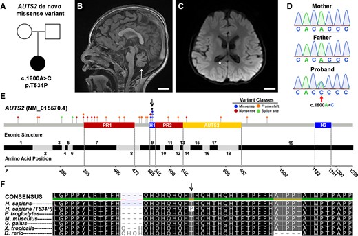 Identification of a de novo AUTS2 variant within a conserved histidine-rich domain. (A) Family pedigree. Circle: female; square: male; filled: affected. (B and C) MRI of affected individual showing reduced cortical area, ventriculomegaly (asterisk) and cerebellar atrophy (arrow). MRI images are arranged in sagittal and coronal planes, respectively. Scale bar = 2 cm. (D) Sanger-based DNA sequence chromatogram of the c.1600A>C AUTS2 variant in exon 9 in the affected patient and absent in her unaffected, healthy parents. (E) AUTS2 genomic organization showing disease-causing variants, key domains and exon structure of the AUTS2 gene. Pathogenic and likely pathogenic variants from the ClinVar database as of January 2021 are represented by circles and shaded according to variant classes. Proline-rich domains (PR1/PR2; containing nonsense and frameshift variants) and histidine-rich domains (H1/H2; containing predominately missense variants) were obtained from UniProt (entry Q8WXX7). The curated AUTS2 protein family domain from PFAM is denoted as AUTS2). Exon locations and numbering in the bottom panel reflect the canonical full-length transcript (NM_015570.4). (F) AUTS2 amino acid conservation within the H1 domain and spanning position 534 across multiple species. Arrow represents the AUTS2 T534P alteration in the affected patient.
