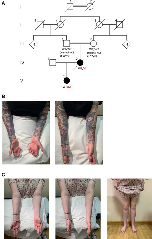 Family pedigree and clinical photography of affected family members. Family pedigree (A), with the arrow indicating the proband and filled symbols denoting affected individuals; squares are males and circles are females. In cases where the genotype was available, it is indicated under the corresponding symbol as WT/WT (wild-type/wild-type) or WT/M (wild-type/mutant). Still photographs showing forearm and intrinsic hand muscle amyotrophy in the proband (B) and a milder degree of forearm, hand and distal leg amyotrophy in the proband’s daughter (C).