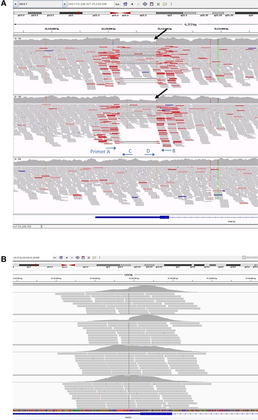 Aligned sequence reads at the PMP22 locus visualized in the IGV browser. Sequence reads from the trio WGS study (A) and the quad WES study (B). In the WGS study, the panels correspond to the proband (top), proband’s daughter (middle) and the proband’s mother (bottom) and the black arrows indicate the 50% reduction in the coverage plot. The approximate primer annealing sites and direction are indicated. In the WES study (panel order from top to bottom is proband, proband’s daughter, proband’s mother, proband’s father), there is a hint of reduced coverage at the PMP22 3′-UTR in the proband and the proband’s daughter, but is not as obvious and well delineated as in the WGS study, and hence could be overlooked. IGV = Integrative Genomics Viewer; WES = whole exome sequencing; WGS = whole genome sequencing.