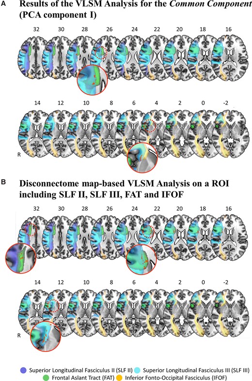 Neuroanatomical analysis. (A) The results of the VLSM analysis using the PCA factor values of the common component (i.e. PCA Component I) as predictive values. The results show two significant lesion clusters (red, with a total volume of 325 voxels). The first and larger cluster (top row) is located within the second branch of the SLF (SLF II, dark blue), the third branch of the SLF (SLF III, light blue) and the FAT (green). The second and smaller cluster (bottom row) is located within the SLF III, the anterior part of the putamen and the IFOF (yellow). Patients with right-hemispheric stroke presenting with a lesion within these clusters were significantly more likely to show an impairment in overall cognitive performance in all three considered cognitive domains, as reflected by the lower factor values in the common component (PCA Component I). (B) The results of the disconnectome map analysis for a ROI including all four white matter tracts identified as affected by the previous VLMS analysis, i.e. the SLF II, the SLF III, the FAT and the IFOF. Patients with right-hemispheric stroke presenting with a lesion within these clusters were significantly more likely to show an impairment in overall cognitive performance in all three considered cognitive domains, as reflected by the lower factor values in the common component. For both panels, lesion voxels that were a significant predictor for the common component factor values are depicted in red (significance level P < 0.05, based on the Brunner–Munzel test, false discovery rate-corrected, 4000 permutations). Lesion clusters and white matter tracts are displayed on the MNI152 template in MNI space, as available in MRIcroGL (https://www.nitrc.org/projects/mricrogl/). The axial slices are oriented according to the neurological convention. The position of each slice in MNI space is indicated by numbers at the top of the respective slices. White matter tracts are depicted according to published probabilistic diffusion tensor imaging atlases2,59 (the probability of voxels belonging to the SLF II (in dark blue), SLF III (in light blue), the FAT (in green) and the IFOF (in yellow) was set at ≥50%).