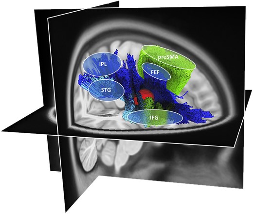 A putative neuroanatomical model. The putative neuroanatomical model explains how a frontal lesion (red volume), located at the strategical intersection of fronto-frontal and fronto-parietal tracts, can disrupt multiple tracts interconnecting cortical areas within the MD network.10 In particular, the affected white matter fibre tracts are the SLF II (dark blue84,161), the SLF III (light blue84,161) and the FAT (green162). The SLF II and III are generally known to connect parieto-temporal areas to frontal areas (SLF II connects the IPL with the frontal eye field2,90,91 and SLF III connects the IPL and the STG with the IFG2,4,69,84,85). The FAT connects the posterior part of the IFG and the pre-SMA.86–89 The illustration was created using the HCP1065.2 mm template and the implemented automated fibre tracking tool, visualized on the respective T1-image implemented in DSIstudio (v.2021.12.03; available at http://dsi-studio.labsolver.org/).