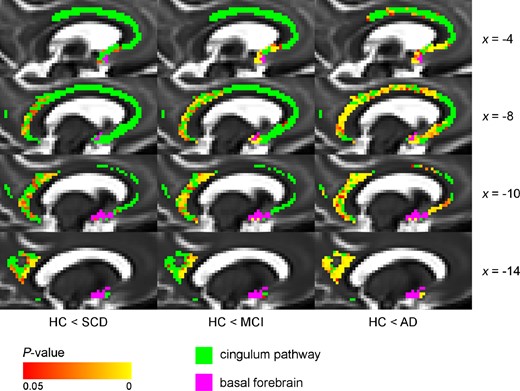 Voxel-wise differences in MD between diagnostic groups and controls (cingulum pathway), controlling for age and sex. The cingulum pathway showed significantly higher MD values in the posterior/retrosplenial cingulate already in the SCD group compared with the HC group. Additional differences were present in the rostral and dorsal anterior cingulate in MCI and Alzheimer’s disease dementia groups. Voxel-wise analyses of the diffusion data (MD values) were performed using non-parametric permutation testing. Identification of significant clusters in the data was performed using TFCE. Significance maps were corrected for multiple comparisons using a familywise error rate of P < 0.05 (non-significant voxels are shown in green). BF mask (in purple) was inflated for illustrative purposes. AD = Alzheimer’s disease dementia.