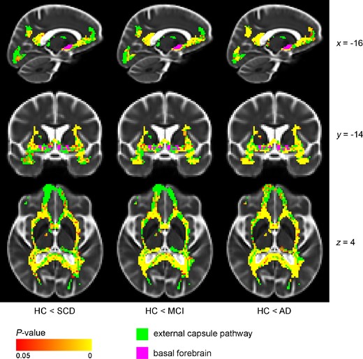 Voxel-wise difference in MD between diagnostic groups and controls (external capsule pathway), controlling for age and sex. The external capsule pathway showed differences in the external capsule, posterior/retrosplenial cingulate and parts of the uncinate fasciculus in SCD and MCI compared with HC. Additional differences were present in temporal and prefrontal areas in the Alzheimer’s disease dementia group. Voxel-wise analyses of the diffusion data (MD values) were performed using non-parametric permutation testing. Identification of significant clusters in the data was performed using TFCE. Significance maps were corrected for multiple comparisons using a familywise error rate of P < 0.05 (statistically non-significant voxels are shown in green). BF mask (in purple) was inflated for illustrative purposes. AD = Alzheimer’s disease dementia.