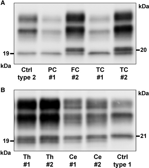 Regional immunoblot profiles of proteinase K–resistant PrPSc fragments in two representative sporadic Creutzfeldt–Jakob disease MV2K cases (#1 and #2). (A) Western blot profile in neocortices showing a dominant 19 kDa (type 2) unglycosylated band in Case #1 and, conversely, a dominant 20 kDa fragment in Case #2. (B) Immunoblot of thalamus showing a similar intensity of 19 and 20 kDa bands and a dominant 20 kDa fragment in the cerebellum (vermis) of both cases. Immunoblots are probed with the mAb 3F4.
