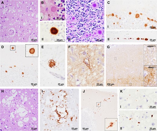 Neuropathologic features of sporadic Creutzfeldt–Jakob disease MV2K subtype. (A) Spongiform change with intermediate size vacuoles. (B) Cerebellar kuru plaques (I = HE; II = PrP IHC; III = periodic acid-Schiff). (C) Plaque-like deposits in the cerebellar granular layer (I) and white matter (II). (D) Kuru plaques in the cerebellar molecular layer and (E) occipital cortex. (F) Perineuronal PrP and (G) deep laminar synaptic staining in neocortex. (H) Large size, confluent vacuoles. (I) Coarse/perivacuolar PrP deposition. (J) Patchy PrP deposits in the cerebellar molecular layer. (K) Prion-related tau secondary tauopathy (I = dots; II = small irregular aggregates). B(I), C–G, I and J: PrP immunohistochemistry with the mAb 3F4; K: tau immunohistochemistry with the mAb AT8.