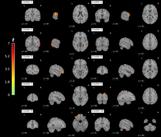 Clusters of false discovery rate corrected correlation between PET acetylcholinesterase hydrolysis rates and change in anterior-posterior critical mean square displacement as a function of reliable proprioceptive cue loss during postural control. MNI space coordinates are provided for cluster centroids. L = left; R = right.