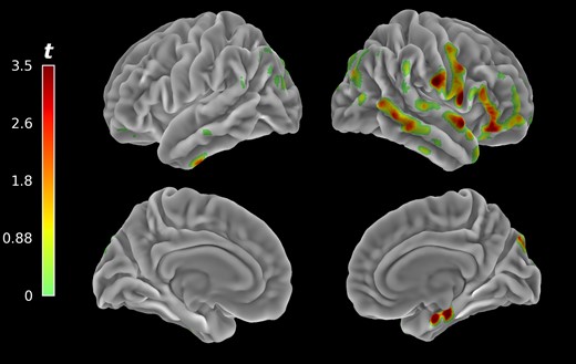 Voxel-wise clusters of significant associations between 11C-methyl-4-piperidinyl propionate PET acetylcholinesterase hydrolysis rates projected unto cortical surface mesh. Associated cholinergic system changes were predominantly present in right hemispheric cortical structures related to visual-vestibular integration and self-motion perception.