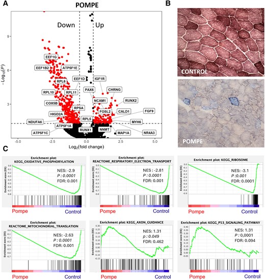 Mitochondrial dysfunction in Pompe muscle samples. (A) Volcano plot of log2 fold change and −log10(P) of Pompe genes compared with control. Control, n = 4; Pompe, n = 8. (B) Representative images of combined cytochrome c oxidase and succinate dehydrogenase (SDH/COX) staining, markers of mitochondrial dysfunction, from control and Pompe muscle samples, with COX-negative fibres stained in blue (×20 magnification). (C) GSEA plots showing enrichment score (ES) of the significant enriched hallmark gene sets in myonuclei. A positive value of ES indicates enriched in Pompe disease, and a negative value indicates enriched in controls. Control, n = 4; Pompe, n = 8. FDR = false discovery rate; GSEA = gene set enrichment analysis; LOPD = late-onset Pompe disease; NES = normalized enrichment score.