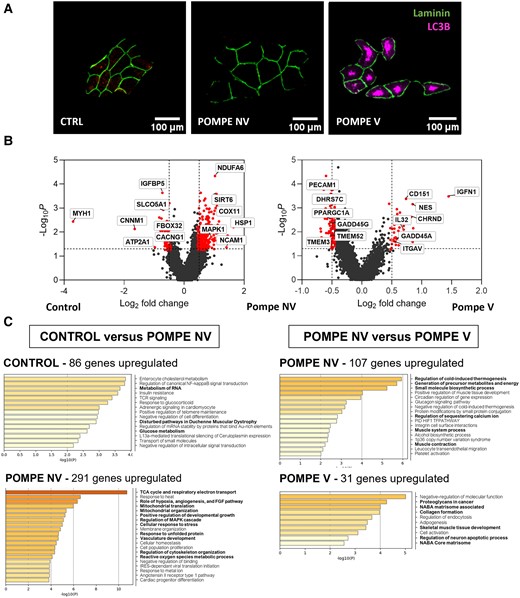 High-resolution spatial transcriptomics application in late-onset Pompe disease. (A) Representative images of region of interest of control, Pompe non-vacuolated (NV) and Pompe vacuolated (V) fibres. Fibre contour and autophagic vacuoles were stained with anti-laminin (green) and anti-LC3B (red) antibodies, respectively. Scale bars = 100 μm. (B) Volcano plots of log2 fold change and log10P-value of Pompe non-vacuolated (NV) genes compared with control (left); and volcano plots of log2 fold change and log10P-value of Pompe vacuolated (V) genes compared with Pompe NV (right). (C) Metascape results for enriched pathways in upregulated genes for Pompe NV versus control and for Pompe V versus Pompe NV. Mann–Whitney U-test. Control, n = 4; Pompe NV, n = 35; Pompe V, n = 32.