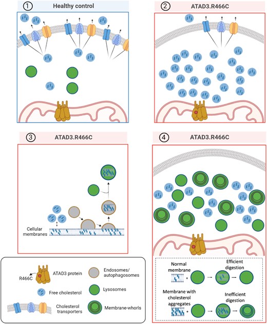 Consequence of elevated cholesterol in ATAD3 disease. (1) Healthy control cell with normal cholesterol and lysosome levels (blue panel). In contrast, ATAD3 mutant cells (red panels) require more cholesterol than normal and the free cholesterol pool can be increased by reducing the number of cholesterol transporters (2), or remodelling cholesterol biosynthesis.6 The abundant free cholesterol leads to cholesterol aggregation in membranes and activation of the endolysosomal pathway to remove the aberrant membranes (3); however, cholesterol-engorged membranes are difficult to digest leading to many lysosomes with membrane whorls that are characteristic of lysosomal storage diseases (4).
