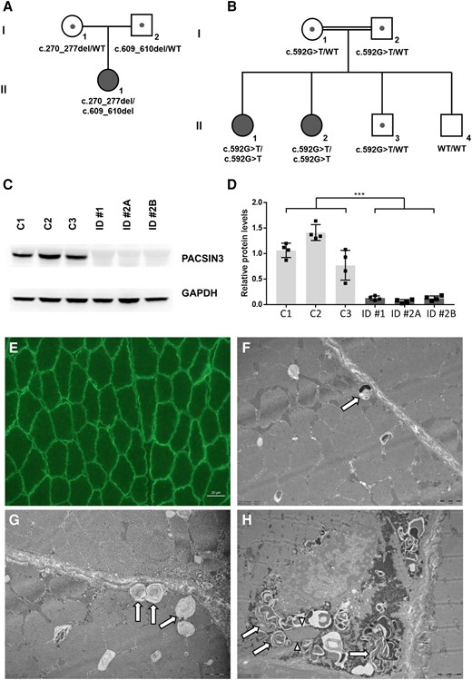 Genetic, biochemical and histological findings in individuals with PACSIN3 deficiency. (A and B) Pedigrees of Family 1 (A) and Family 2 (B) with pathogenic variants in PACSIN3. Mutation status of affected (filled symbols) and healthy (open symbols) family members is shown. (C) Representative immunoblotting image of patient-derived (ID 1, ID 2A, ID 2B) and control (C1, C2, C3; age-matched, female) fibroblasts. In patient-derived cell lines, PACSIN3 protein is not detectable. The corresponding unmodified full-length blots can be found in the Supplementary material. (D) Quantitated density of immunoblot bands from four independent experiments. Average values are presented as the mean ± standard error of the mean (SEM); ***P < 0.001 significantly different from controls. (E) Immunofluorescence of caveolin-3 in biopsied muscle tissue derived from Individual 1, showing normal pattern of sarcolemmal immunoreactivity (scale bar = 20 µm). (F–H) Electron microscopy images of biopsied muscle fibres from Individual 1. (F and G) Abnormal vacuoles preferentially found in close proximity to the sarcolemma (arrows), containing membranous material, which in some of the vacuoles coalesces to form membranous cytoplasmic bodies (scale bars = 1 µm). (H) Focal subsarcolemmal build-up of glycogen granules and of membranous cytoplasmic bodies combined with proliferations of membranous tubules forming loops (arrows) and tubular aggregate-like stacks (arrowheads) (scale bar = 2 µm). WT = wild-type.