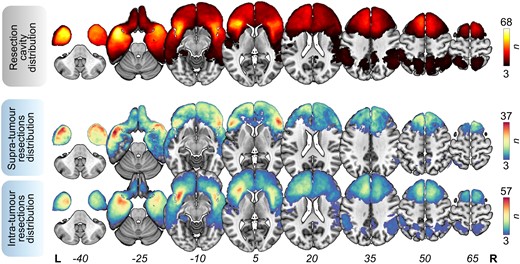 Resection overlap maps. Overlap maps of resection cavities (top), supra-tumour resections (middle) and intra-tumour resections (bottom). These maps were thresholded in such a way that only voxels affected in at least three patients are shown. Bars indicate the number of overlapping lesions. n = 400 patients (left = 234, right = 166). L = left; R = right.