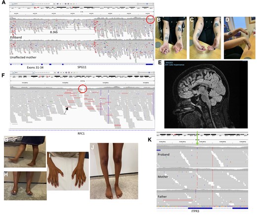 Illustrative cases. (A) Integrative Genomics Viewer (IGV) showing aligned sequence reads for proband and unaffected mother at the SPG11 locus. An 8.3 kb deletion is carried by the proband and mother, point mutation is carried only by the proband (red circle). (B–D) Clinical images of the proband. (E) Sagittal MRI midline slice showing corpus callosum atrophy. (F) IGV showing loss of read depth in intron 2 of RFC1 (red circle). Reads with red outline (black arrow) indicated an unmatched read-pair suggestive of an expansion. (G and H) Clinical images of the asymptomatic mother easily walking and standing on heels. (I and J) Wasting of distal upper and lower limbs in the proband. (K) IGV showing a variant in ITPR3 present in the proband and mother, but absent in the father (green arrow).