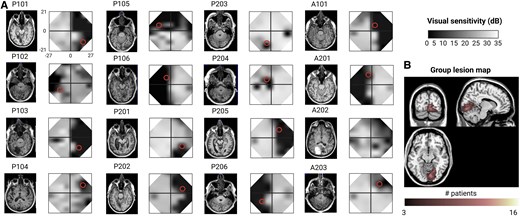 脳刺激が脳卒中後の視覚回復を促進(Brain stimulation improves vision recovery after stroke) 脳刺激が脳卒中後の視覚回復を促進(Brain stimulation improves vision recovery after stroke)
