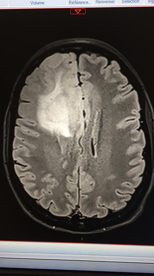 A photograph of a screen showing the author’s first MRI after her grand mal seizure, Paris, 24 March 2020, 7:42 p.m. Photograph by the author’s husband.