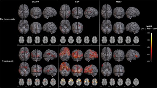 Longitudinal protective effects of TMEM106B-rs1990622G allele dosage on brain volume