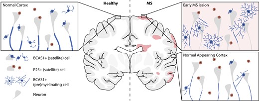 BCAS1-positive oligodendrocytes enable efficient cortical remyelination in multiple sclerosis