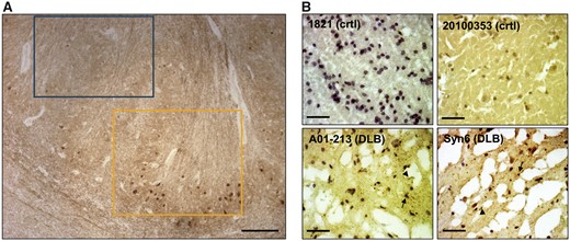 IHC confirmation of synucleinopathy in DLB frontal cortical samples. (A) IHC of the formalin-fixed striatum of MGH DLB brain #1594 with αSyn monoclonal antibody 2F12 demonstrates the striking local heterogeneity of cytopathology. Yellow box: area of high density of Lewy cytopathology; blue box: immediately adjacent area devoid of IHC-detectable αSyn aggregates. Scale bars: 300 μm. (B) Small frozen pieces of tissue were excised from locations adjacent (within ∼5 mm) to the frozen pieces we used for our biochemical extractions. The resultant cryostat sections were stained with αSyn monoclonal antibody 2F12 and nuclei counterstained with haematoxylin. Representative images from two control and two DLB brains show ice crystals resulting from variable freezing of the unfixed tissue. Arrows exemplify LBs; arrowheads exemplify Lewy neurites. Scale bars: 80 μm.
