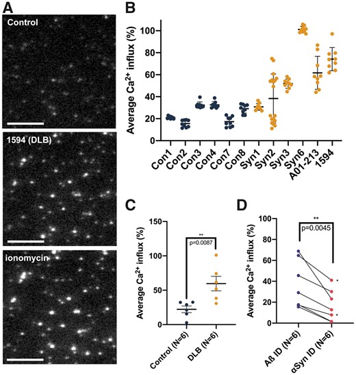 Quantitative measurement of membrane permeabilization upon applying HMW fractions of soluble brain extracts via fluorescence imaging. (A) Images obtained through TIRF microscopy show an untreated vesicle sample (top, ‘Control’), a vesicle sample treated with soluble, HMW brain material from DLB patient 1594 (middle) and a sample treated with ionomycin as a positive control (bottom). Scale bars are 3 μm. (B) Brain homogenates display variable vesicle permeabilization capability between different cases but low variability within replicates of the same samples. Means with standard deviations are shown. (C) Mann–Whitney comparison of ranks analysing average Ca2+ influx measured from six DLB and six control brains reveals significantly elevated permeabilization of lipid membranes by soluble extracts from DLB patients (P = 0.0087). For each patient sample, nine technical replicates were used to generate the data point. Means with SEMs are shown. (D) Immunoneutralization of DLB cytosolic extracts with 2F12 anti-αSyn antibody (2F12, right) reduces the DLB extract-induced permeabilization of the vesicles compared to immunoneutralization anti-Aβ antibody (4G8, left) (paired T-test, P = 0.0045). For each patient sample, nine technical replicates were used to generate the data point. Each pair of points connected by a line represents a single cytosolic HMW extract. The two pairs of points denoted by a ‘*’ came from a single DLB brain (Syn2).