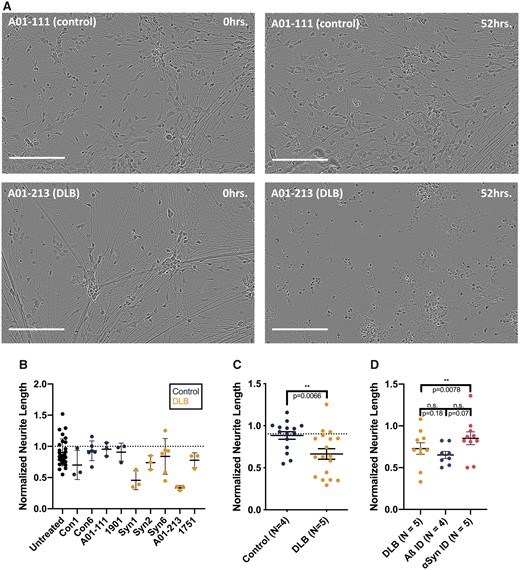 Treating iPSC-derived human neurons with Lewy-associated brain extracts. (A) Neurogenin-induced human neurons were treated with protein-normalized volumes of sonicated Lewy-associated brain extracts. Neurite morphology was monitored for 88–96 h. Images were analysed by applying a neurite mask (Supplementary Fig. 5) and automatically quantifying mean neurite length. In these representative images, neurons treated with αSyn-enriched control brain extract (top) show largely intact neurites at 52 h, whereas neurons treated with A01-213 DLB αSyn-enriched extract display neurite retraction (bottom). Images shown from each brain sample are taken from identical fields at different time points. Bars are 200 μm. (B) Mean neurite length calculated across four images per well at 88 h was normalized to the mean neurite length at t = 0. While the amount of αSyn levels applied to each well was not normalized, these levels did not correlate with the extent of neurite retraction (not shown). Means with standard deviations are shown. (C) Pooling of data collected from four non-synucleinopathy control extracts and five DLB patient extracts across three separate experiments shows a significantly greater neurite retraction in neurons treated with DLB extracts (P = 0.0066, Mann–Whitney comparison of ranks). Means with SEMs are shown. (D) Human iPSCs were treated with two extracts from five DLB brains, each split into three aliquots: one was applied directly; one was pre-incubated with 2F12, a monoclonal antibody to αSyn; and a third was pre-incubated with 4G8, a monoclonal antibody to Aβ. Immunoneutralization of αSyn in these extracts restored the length of neurons treated compared with neurons treated with non-immunoneutralized aliquots of the same DLB extracts (P = 0.0078, Wilcoxon paired comparison of ranks). Each point represents the mean of technical triplicates from a single experiment. Means with SEMs are shown.