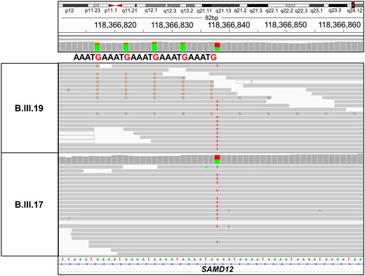 Visualization of SAMD12 TTTCA intronic repeats in the Integrative Genome Viewer (IGV). WGS reads visualization in IGV revealed an intronic repeat “TTTCA” in SAMD12 gene at coordinate chr8:118366817-118366914 (hg38/GRCh38) in the affected individual (B.III.19) whereas it was absent in the unaffected individual (B.III.17).
