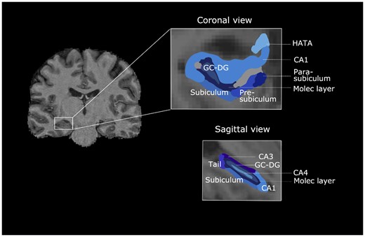 Freesurfer parcellation of hippocampal subfields in coronal and sagittal views. CA1–4 = cornu ammonis; HATA = hippocampus-amygdala-transition-area; Molec layer = molecular layer; GC-DC = granule cell layer of dentate gyrus.