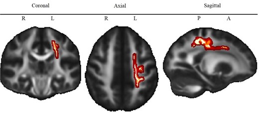 Association of executive function scores and white matter anisotropy. Note. Red to yellow colour indicates voxels for which FA is significantly (TFCE corrected P < 0.05) lower in ACHD compared to controls. Brighter colour indicates higher significance. L = Left, R = Right, P = Posterior, A = Anterior. The map of the different tracts is shown in Supplementary Fig. 2.