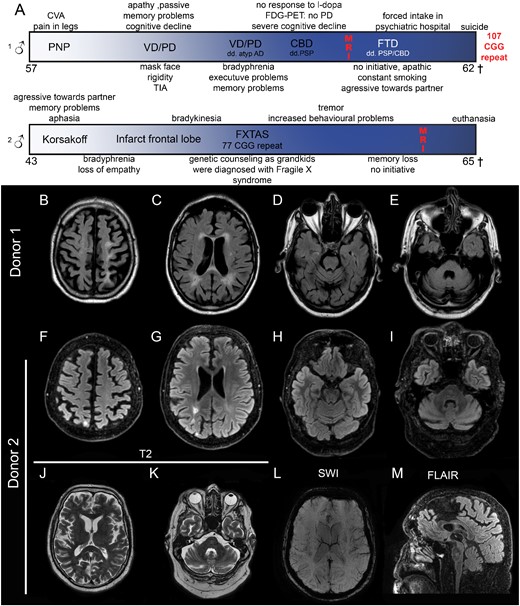 Clinical course and imaging results of Donors 1 and 2. Clinical course (A) shows moment in time of MRI. General mild atrophy is observed (B, F). Ventricles are slightly dilated and Donor 1 shows periventricular white matter lesions (C), Donor 2 shows an increased signal due to an infarct (G). Slight cerebellar atrophy can be seen in both donors (D, E, H, I). Enlargement of the fourth ventricle, but no FXTAS-characteristic middle cerebral peduncle sign can be seen. T2-fluid-attenuated inversion recovery of Donor 2 does not show increased insular and middle cerebral peduncle signal intensities (J, K), no abnormalities in vasculature (K) and no thinning of the corpus callosum (M). CVA, cerebrovascular accident; PNP, polyneuropathy; VD, vascular dementia; PD, Parkinson’s disease; AD, Alzheimer’s disease; CBD, corticobasal degeneration; FTD, frontotemporal dementia; PSP, progressive supranuclear palsy.