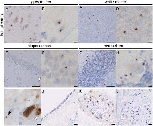p62-Pathology in Donor 2. Abundant p62-positive nuclear inclusions in the frontal cortex grey matter (A, B) and white matter (C, D). The hippocampus shows nuclear inclusions in the CA4 neuron (white arrowhead) and the dentate gyrus (E, F). In the cerebellum, inclusions are seen in the white matter and granular layer (G, H). No inclusions were seen in the Purkinje cells, whereas most Bergmann glia showed inclusions (H). Pathology was also seen in the dopaminergic neurons (white arrowhead) and astrocytes (black arrowhead) in the substantia nigra (I), ependymal (J), extra-axial cells of the third nerve (K) and choroid plexus cells (L). Scale bar A is 50 μm; Scale bar B, D, F, H, I–L is 10 μm; scale bar C, E, G is 100 μm.