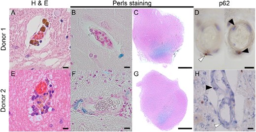 Vascular pathology of Donors 1 and 2. Brown iron-like deposits are seen in both donors (A, E), which stain blue in a Perls staining (B, F). Both donors showed abnormal increased iron deposits in the ventral part of the substantia nigra (C, G). Throughout the brain, inclusions were seen in the endothelial cells (black arrowhead) and the pericytes (white arrowhead) (D, H). Scale bar A, B, D, E, F, H is 10 µm; scale bar C, G is 0.5 cm.