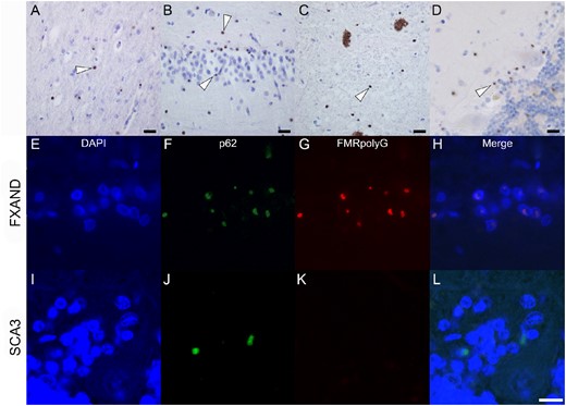 Figure 4 FMRpolyG-positivity in Donor 2. FMRpolyG (1C5)-positive inclusions are seen in the frontal cortex (A), hippocampus (B), substantia nigra (C) and cerebellum (D). Inclusions are indicated with white arrowheads. Co-localization of p62 and FMRpolyG (NTF1) immunopositivity in the Bergmann glia of the cerebellum in Donor 2 and spinocerebellar ataxia 3 (SCA3) donor. Bergmann glia shown with DAPI (E, I) showed inclusions with p62 (F, J) and FMRpolyG (G, K). Co-localization of the immunopositivity shows overlap in FXAND (H) and not in SCA3 (L). Scale bar is 10 μm.