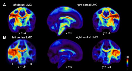 Connection probability of two distinct larynx cortical representations. (A) Population probability maps showing the likelihood of structural connectivity of the left and right dLMC and (B) left and right vLMC with dark-red marking 100% and dark-blue 0% connection probabilities.