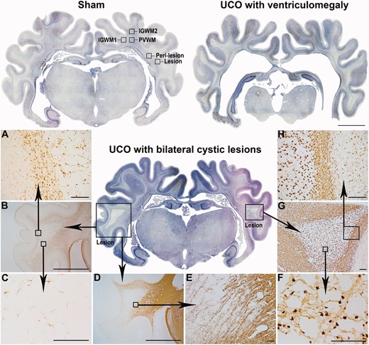Spectrum of macroscopic white matter degeneration at 21 days. Examples of whole coronal sections after 21 days of recovery in the sham group with regions of interest labelled (top left) and the two predominant patterns of macroscopic WMI in the 21d-UCO group: White matter atrophy with ventriculomegaly (top right) and bilateral cystic white matter lesions (centre) which were primarily observed in the temporal lobe white matter. Serial images were taken at ×2.5 magnification and stitched together (scale bar = 1000 µm). (A−H) Representative higher magnification photomicrographs of the cystic lesions. (A−C) (Taken at ×10, ×2.5, ×20, respectively) show GFAP-positive astrocytes illustrating that a dense border of astrogliosis formed around the perimeter of the lesions (A) while a marked reduction in the numbers of astrocytes was observed within the centre of the lesion (C). (D−E) (Taken at ×2.5 and ×4, respectively) show that MBP-positive myelin was severely disrupted within and surrounding the lesion. (F−H) (Taken at ×40, ×4 and ×10, respectively) show Iba-1-positive microglia with darkly stained amoeboid morphologies in the centre of the lesion (F) and a dense border of amoeboid microglia surrounding the perimeter of the lesion (H). (Scale bar = 1000 µm for ×2.5, 200 µm for ×4, ×10 and ×20 magnifications, and 100 µm for ×40 magnification).