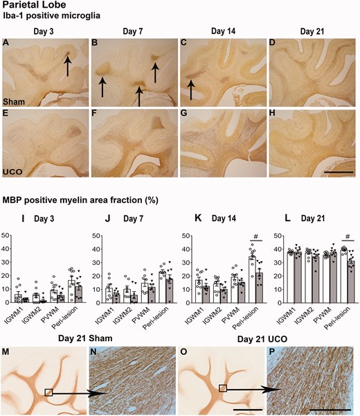 Parietal white matter histological outcomes. Top panels: Coronal sections showing the parietal lobe stained with Iba-1 taken at ×2.5 magnification (scale bar = 1000 µm). Note the transient nature of microglial aggregates (arrows) within the sham groups (A−D) compared with the profound changes seen throughout the entire parietal lobe in the UCO group (E−H). Middle panels (I−L): graphs showing changes in myelination quantified as area fraction of MBP positive staining after sham occlusion (white columns) and UCO (grey columns). Three-way ANOVA including time and the three regions (IGWM1/2 and PVWM) as repeated measures showed a significant reduction in MBP positive myelin in the UCO groups within the parietal lobe regions (P < 0.05). Two-way ANOVA including time as a repeated measure showed a significant reduction in MBP positive myelin in the UCO groups within the peri-lesion region of the temporal lobe (P < 0.05). Statistical significance shown on the figure was determined on individual time-points by one-way ANOVA for the peri-lesion region (#P < 0.05 sham versus UCO). Data are means ± SEM. N = Sham/UCO, MBP: 3d 7/8, 7d 7/8, 14d 9/8, 21d 9/9. Bottom panels: ×2.5 magnification images (M, O) of the parietal lobe stained with MBP with representative ×20 images (N, P). Note that the MBP positive myelin appeared morphologically similar between sham and UCO groups at 21 days (Scale bars = 1000 µm for ×2.5 and 200 µm for ×20 images).