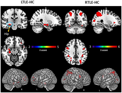 Group comparisons for TLE and HCs. Regional activation associated with SME minus math condition contrast. Surface rendering and slices in vertical panels show significant activation for LTLE versus HC and RTLE versus HC groups. PFDR corrected t-statistic <0.05, cluster level. Hip = hippocampus.