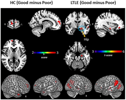 PAM performance (Good versus Poor) within the LTLE and HCs. Regional activation associated with SME minus math condition contrast. Surface rendering and slices in vertical panels show activation for Good minus Poor subgroups of HC and LTLE. PFDR corrected t-statistic <0.05, cluster level. Hip = hippocampus.