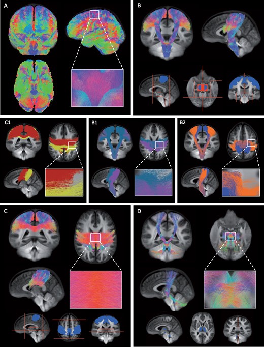 The tracts of interest.(A) Whole-brain tractogram was created on the group WM fibre orientation template using probabilistic tractography. (B) The CST was identified from the whole-brain tractogram using seed regions of interest located in the primary motor cortex (M1), primary somatosensory cortex (S1) and midbrain (blue). Exclusion regions were drawn manually to exclude tracts entering the cerebellum, thalamus and corpus callosum, and tracts terminating posterior or anterior to the CST (red). Within the CST, we investigated the proportion of damage observed within (B1) M1 (blue) and S1 (pink) tracts using either the pre-central or post-central gyrus as inclusion region and (B2) tracts related to upper (blue) or lower limb (orange) movements specifically using fMRI activation maps. (C) The IHST were selected using the right and left pre- and post-central gyrus (blue) and to prevent tracts from running anterior, posterior or inferior several exclusion planes were used (red). (C1) The interhemispheric tracts between left and right S1 (yellow) and left and right M1 (red). (D) The CTT were selected using seed regions within the superior cerebellar peduncle, red nucleus and thalamus (blue) and two sagittal exclusion planes were used superior and inferior of the decussation (red). (A–D) The colour of the tracts indicates the local fibre orientation (green: dorsal-ventral, red: left-right, blue: cranial-caudal).