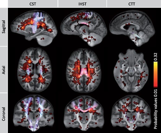 Lesion probability map and tracts of interest. This figure demonstrates the probabilities of lesions occurring across the brain across MS patients with the motor tracts visualized in an overlying manner. Low probability values are shown in red and higher values are shown in yellow. The maximum probability was 32%, indicating that lesion pathology occurred in the same location in 32% of the patients. The probability map intersected with 19.9% of the CST, 19.2% of the IHST and 12.6% of the CTT. The maximum proportions of patients with lesions intersecting with these tracts were only 28.6% for the CST and IHST and 14.3% for the CTT.
