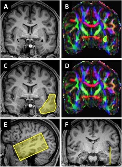 Segmentation of extreme capsule streamlines. (A, C and F) Coronal reformatted MPRAGE (magnetization-prepared rapid acquisition with gradient echo) images. (E) Sagittal reformatted MPRAGE image. (B and D) Corresponding colour-coded fractional anisotropy maps: the arrows in A show the location of the temporal stem in both hemispheres. The yellow circle in B (ROI1) includes all green voxels in anterior extreme capsule/temporal stem at the level of the anterior commissure including extreme capsule streamlines. The yellow area in C (ROI2) covers the entire cross-section of the anterior temporal lobe. ROI3 (E and F) was placed in a sagittal plane barely cutting the ground of the temporal sulcus to segment cortical projection streamlines of the temporal lobe.