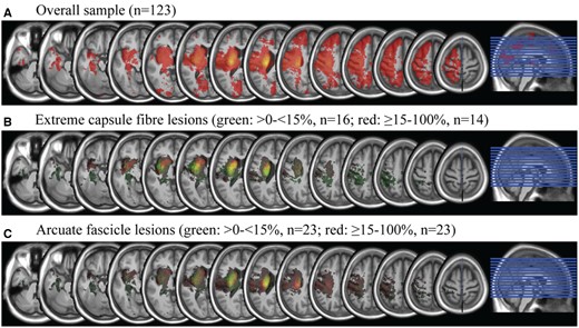 Lesion overlap of all patients and subgroups with extreme capsule fibre and arcuate fascicle lesions. Equidistant slices from z = −33 to z = 64.