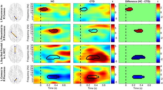 Diagnostic group differences in causal information flow. Time-frequency plots of effective connectivity patterns (represented as t-statistics) for healthy controls (HC, left), individuals with chronic tic disorder (CTD, middle), and the between-group differences (right). The precuneus in the HC group displayed greater connectivity with the right occipital and left precentral gyrus (red in difference plots), while the CTD group showed greater information flow with frontal and left occipital cortices (blue in difference plots). The dashed line represents stimulus presentation at t = 0. L, left; Med, medial; MCC, midcingulate cortex; R, right; Sup, superior.
