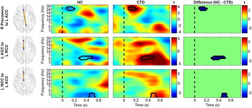 Significant causal interactions involving the anterior cingulate. Time-frequency plots of effective connectivity patterns (represented as t-statistics) for healthy controls (HC, left), individuals with chronic tic disorder (CTD, middle), and the between-group differences (right). Individuals with CTD exhibited greater effective connectivity (blue in difference plots) from the right precuneus to anterior cingulate cortex (ACC), as well as bidirectionally between the ACC and midcingulate cortex (MCC). The dashed line represents stimulus presentation at t = 0. L, left; R, right.