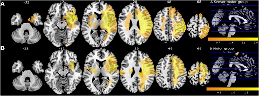 Lesion overlay map of stroke lesion location of patients with available magnetic resonance imaging (MRI) scan (n = 30) displayed for sensorimotor group (A) and motor group (B) separately. Colour indicates increasing number of patients with inclusion of that voxel into the lesion from orange to yellow (low number: orange; high number: yellow). Figure adapted from De Bruyn et al.17