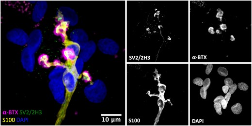 Close congruence between motor nerve terminal and tSCs at the human NMJ. Representative confocal micrograph of a human NMJ from the PB muscle. Triple labelling of the basic cellular components of the NMJ; skeletal muscle fibre (AChRs; magenta), motor nerve terminals (green) and tSCs (yellow). The micrograph demonstrates a typical ‘healthy’ NMJ—the endplate is fully innervated, and there is close congruence between the nerve terminals and tSCs. The merged image shows terminal Schwann cells (tSCs) labelled with antibodies against S100 (yellow), nerve terminals labelled with antibodies against 2H3 and SV2 (green), acetylcholine receptors (AChRs) labelled with α-BTX (magenta), and nuclear staining with DAPI (blue). Scale bar = 10 µm.