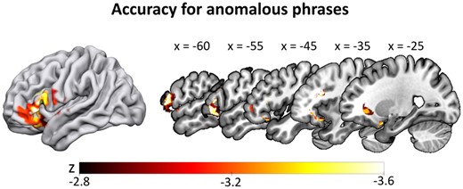 SVR-LSM results for the accuracy data in the anomalous condition. Lower accuracy for anomalous phrases (controlled for all other conditions) correlated with a lesion cluster spanning the left inferior frontal gyrus and temporal pole. Thresholded at voxelwise P < 0.005 and clusterwise FWE P < 0.05 (ranging from z = −2.82 to −3.54), with lesion size and the two other conditions regressed out of both behavioural and lesion data.