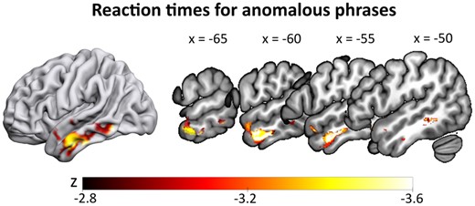SVR-LSM results for reaction times in the anomalous condition. Slower reaction times for anomalous phrases (controlling for all other conditions) correlated with lesions in the left anterior temporal lobe and middle temporal gyrus. Thresholded at voxelwise P < 0.005 and clusterwise FWE P < 0.05 (ranging from z = −2.77 to −3.54), with lesion size regressed out of both behavioural and lesion data.