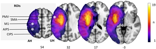 Stroke lesions and motor network ROIs. All masks of stroke lesions are displayed on the left hemisphere, overlaying a T1-weighted template in MNI space (z-coordinates below each slice). The colour intensity indicates the number of subjects of whom lesion voxels lay within the coloured region. Motor ROIs (M1, PMV, SMA, AIPS and CIPS) are displayed respective to the stroke lesions.